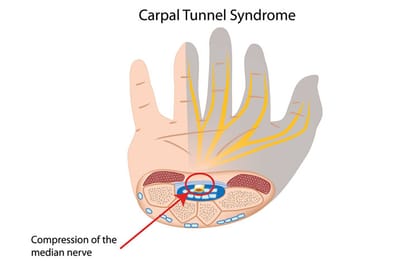 Exercise of Carpal Tunnel Syndrome