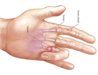 Exercises for Trigger Finger!!