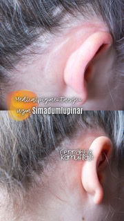 Ameliyat İzi geçer mi?/DOES THE SURGERY TRACE GO?  image