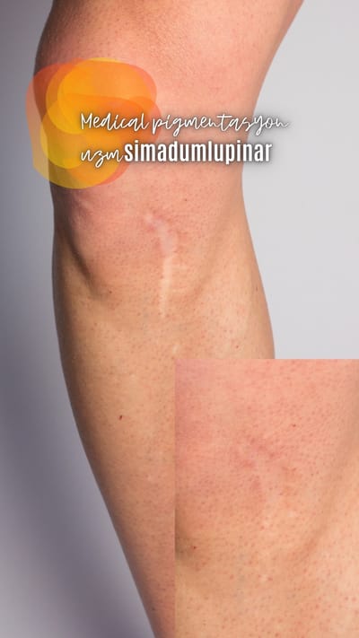 Ameliyat İzi geçer mi?/DOES THE SURGERY TRACE GO?  image