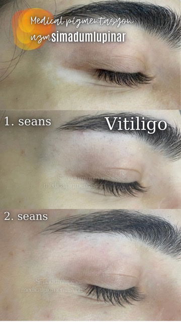 Vitiligo Tedavisi / VITILIGO TREATMENT image