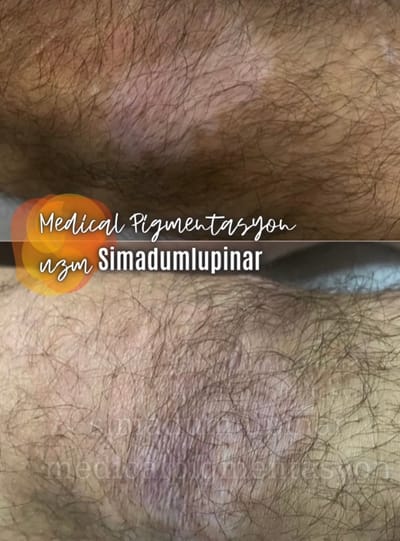 Vitiligo Tedavisi / VITILIGO TREATMENT image