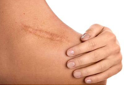 Microiğneleme/ Micropuntura /MICRONEEDING/MICROPUNTURA image