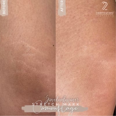 Çatlak Nasıl Geçer ? HOW DOES THE CRACK PASS?   image