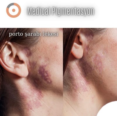 Porto Şarabı Lekesi nasıl geçer ?/HOW DOES A PORTO WINE STAIN GO?  image