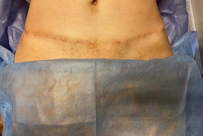 İzler Neden Olur ? Tedaviler nelerdir ?  image