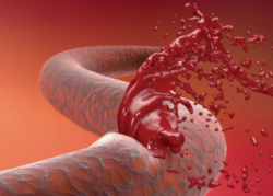 Catastrophic Bleeding