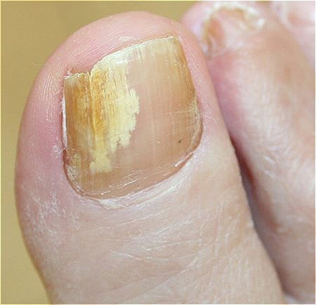 Fungal nails