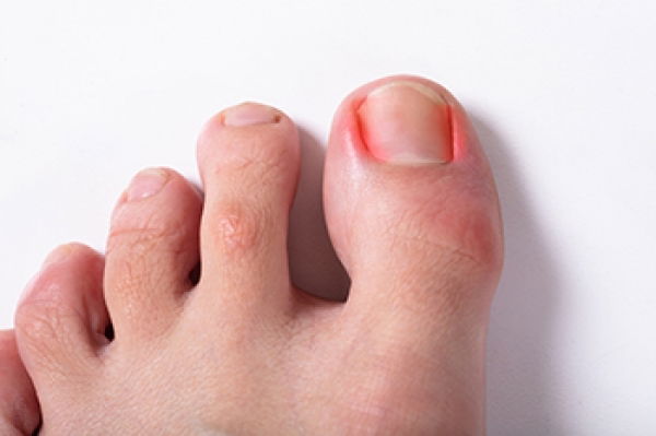 Ingrowing toe nail