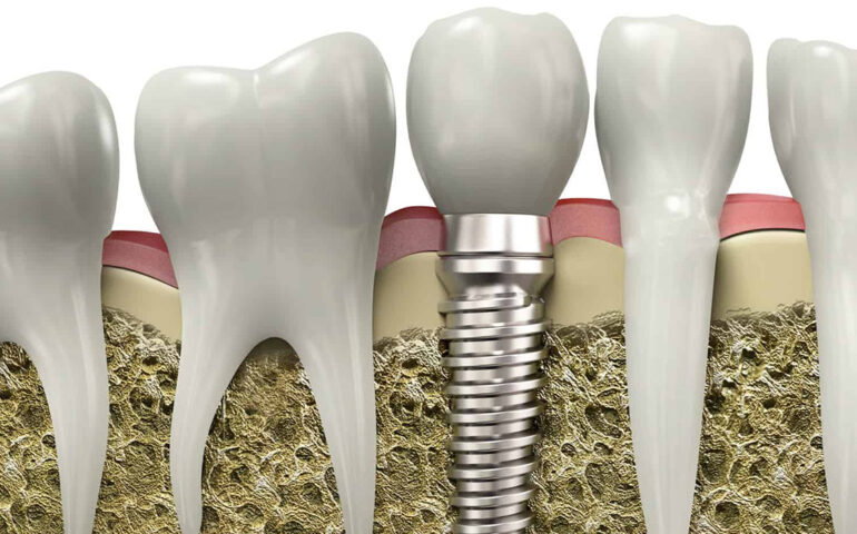Dental Implants