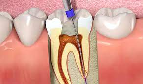 ENDODONCIA