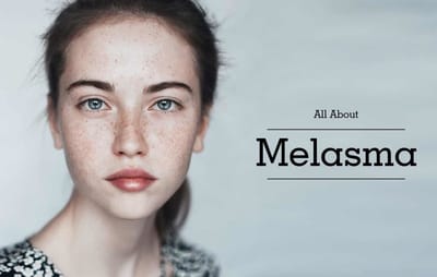 Home Remedies For Melasma Treatment