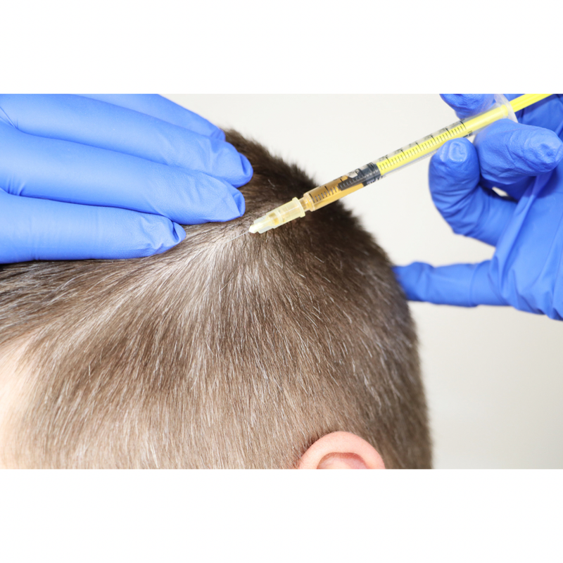 MESOTHERAPY - HAIR