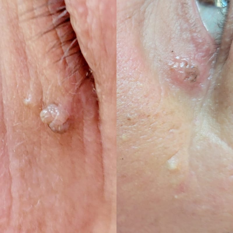 Skin Tag Removal