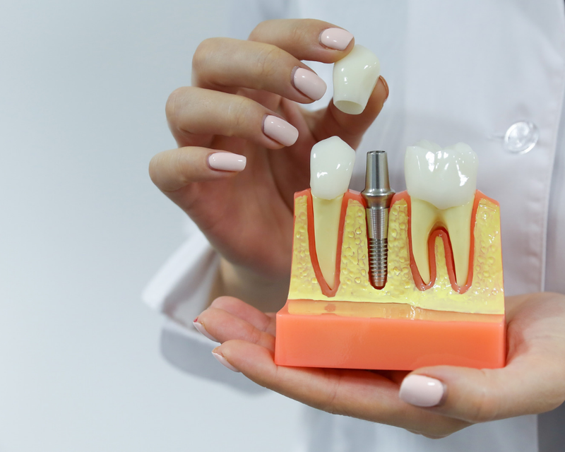 Dental Implants