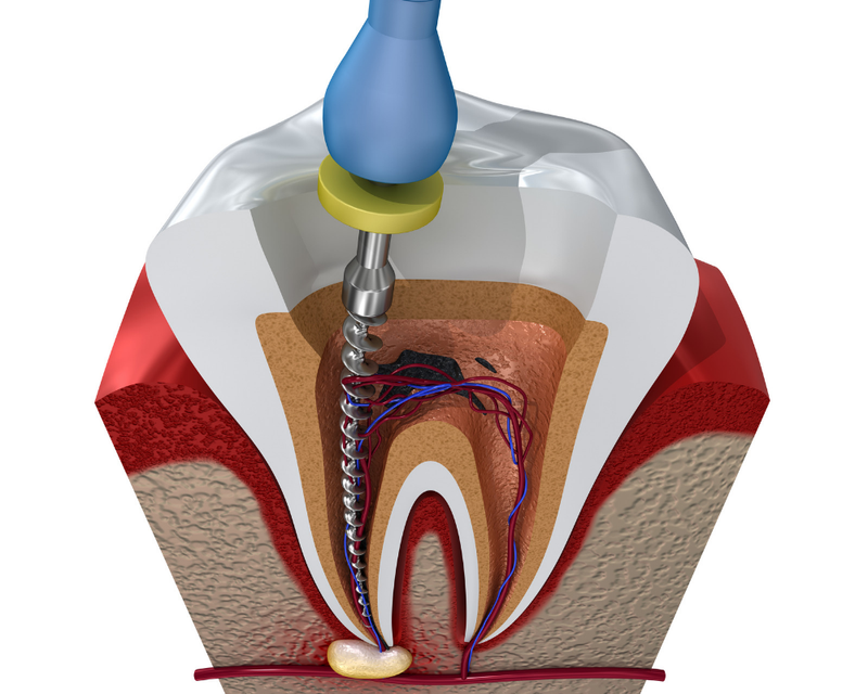 Root Canal Treatment