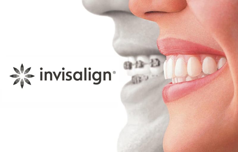 Aligners