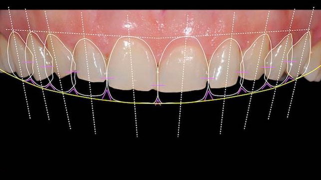 Digital Smile Designing