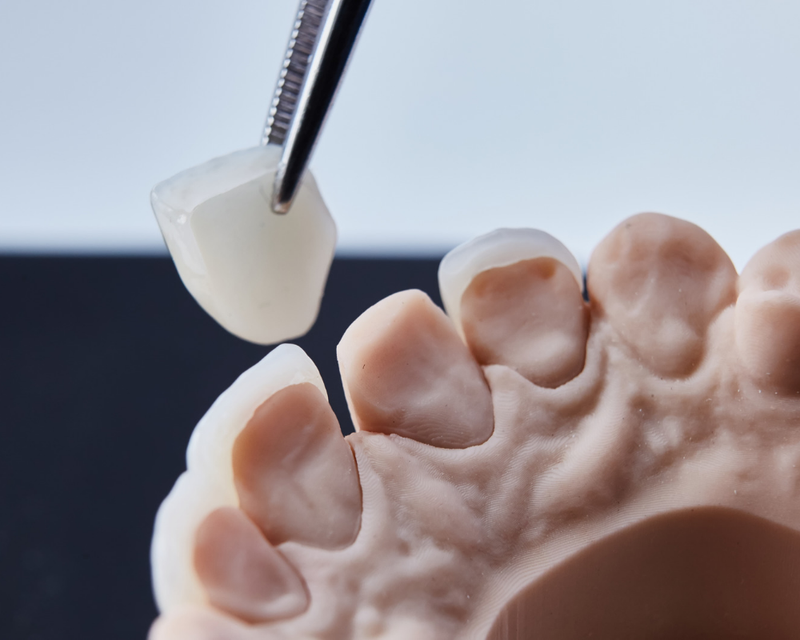 Cosmetic Veneers