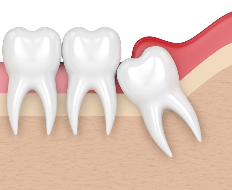 Wisdom Teeth Removal