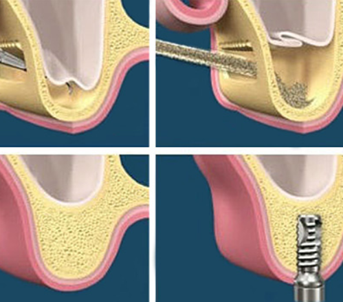 Sinus Lift Surgery