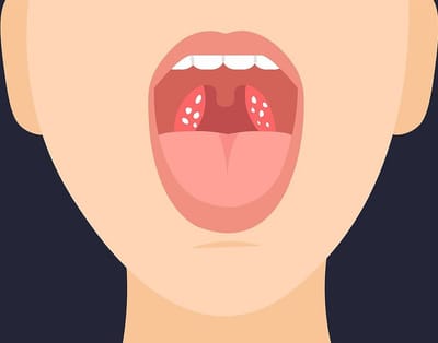 Αμυγδαλίτιδα