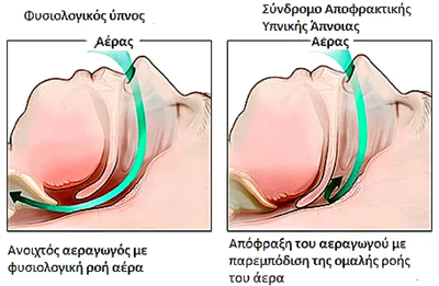 Υπνική άπνοια