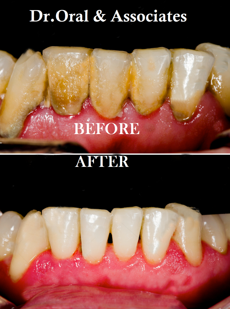 Dental Scaling