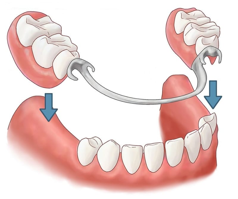 Removeable Partial Denture