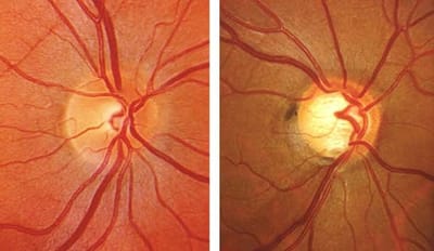 ARE YOU AT RISK OF DEVELOPING GLAUCOMA?