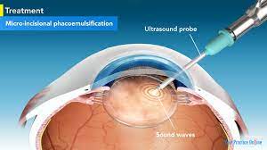 CATARACT PHACOSURGERY