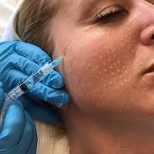 MESOTHERAPY AND SKIN BOOSTERS