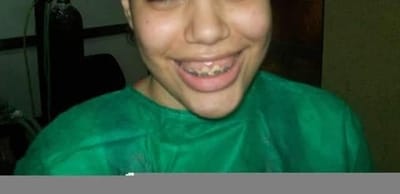 بروز شديد بالفك العلوي