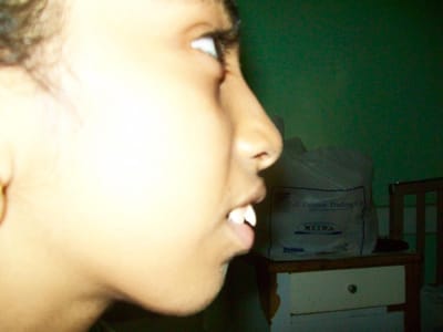 عملية تعديل جراحي لعظام الوجه والفكين.