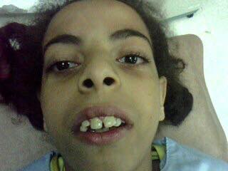 عملية تعديل جراحي لعظام الوجه والفكين.