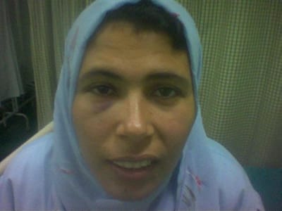 عملية تعديل لعظام الوجه والوجنه.