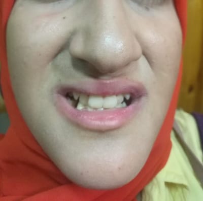 عمليه تعديل جراحي لبروز في الفك السفلي.