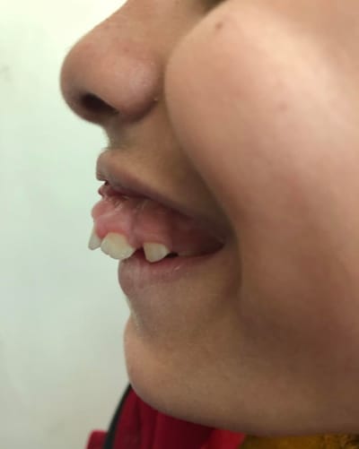 عمليه تعديل لبروز في عظام الفك العلوي.