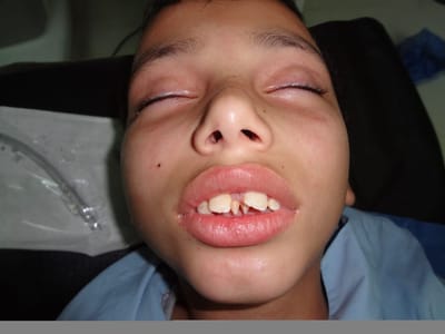 إزالة التيبس العظمى وتحرير مفصل الفك السفلي وتمكن من فتح الفم.