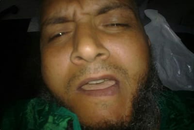 ازاله التيبس العظمى بين راس مفصل الفك وقاع الجمجمة.