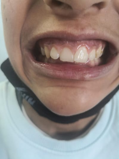 عمليه تعديل جراحي لعظام الوجه والفكين.