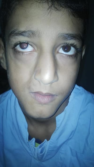 علميه اصلاح جراحي لحاله ضمور شديد في الناحية اليمني من الوجه Pary Romberg syndrome.