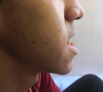 عمليه تعديل جراحي لبروز في عظام الفك السفلي وإصلاح العضه الاماميه المفتوحه.