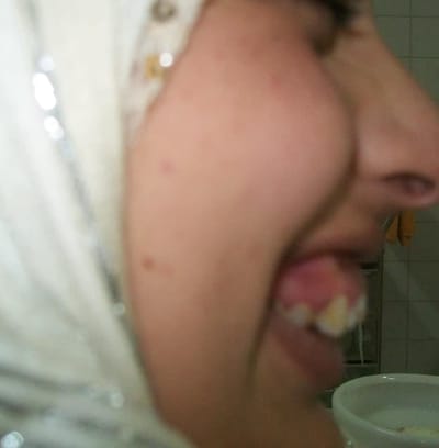 عمليه تعديل جراحي لعظام الفكين وعلاج ابتسامه لثويه.