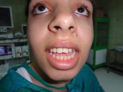 عمليه تعديل جراحي لعظام الفكين وإصلاح عضه اماميه مفتوحه.