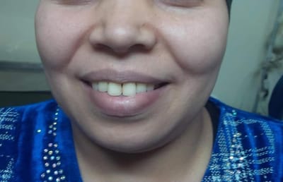 عمليه تعديل جراحي لبروز في عظام الفكين مع رفع مستوى الخدين الي أعلى وكاموفلاج للوجه وعضلات الوجه.