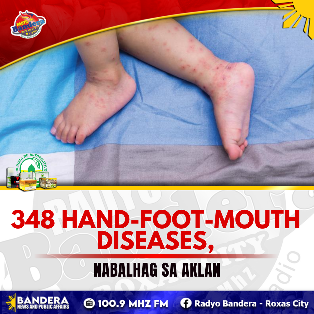 REGIONAL | 348 KASO SANG HAND-FOOT-MOUTH DISEASE, NABALHAG SA AKLAN