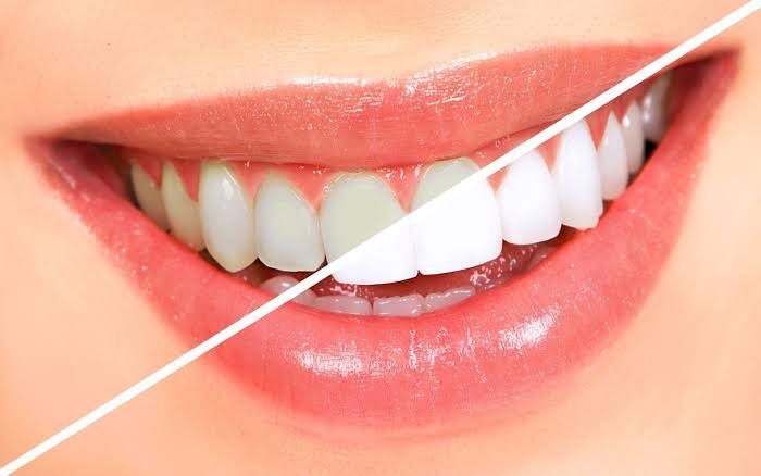 What Is Teeth Whitening