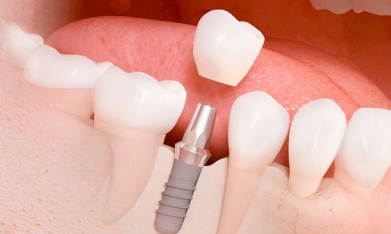 Implantes