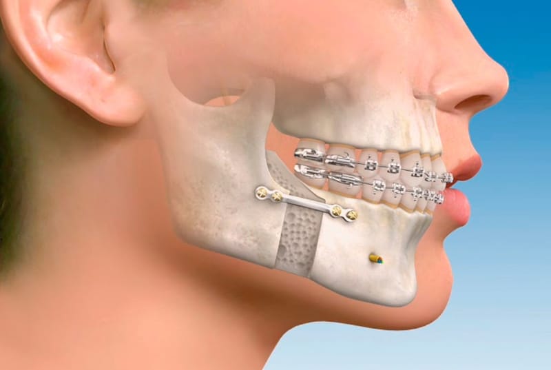 Cirugía Maxilofacial